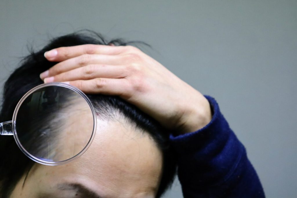 そうだイケオジになろう
毛髪・髪型問題
生え際の写真