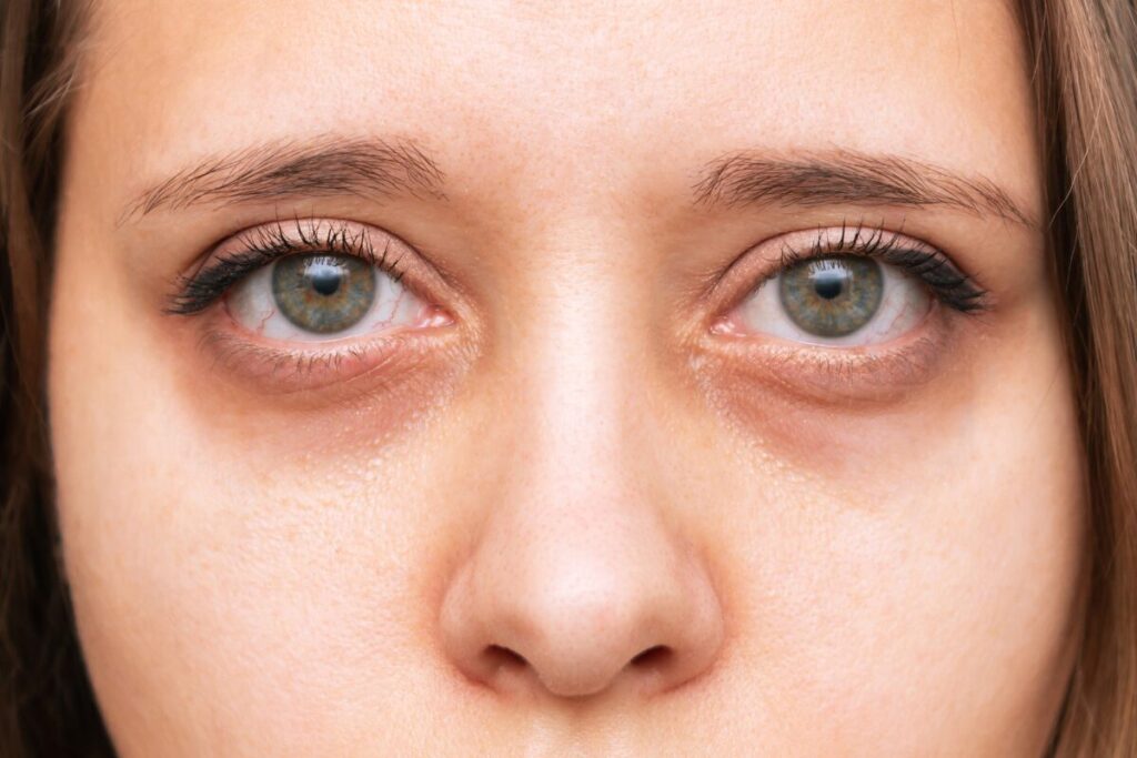 中高年のかほり
内臓疾患と共に
目の下にクマの不健康そうな女性