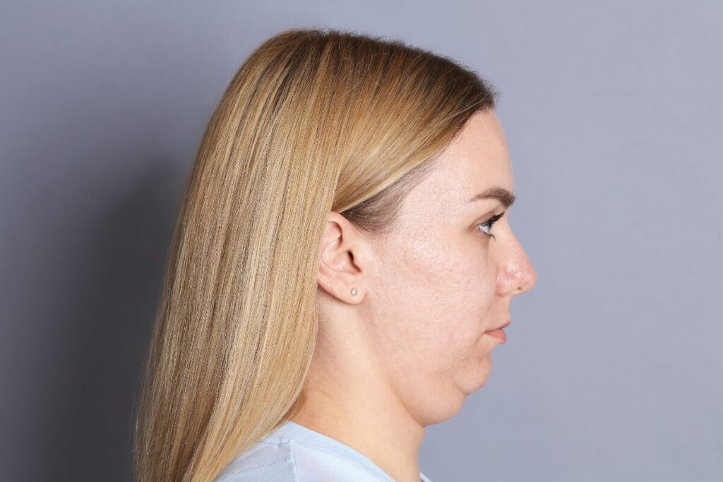 姿勢が整えば小顔になる説？
大きく見える顔
二重アゴの女性